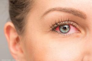 Characteristics of dry eye disease in patients with autoimmune diseases