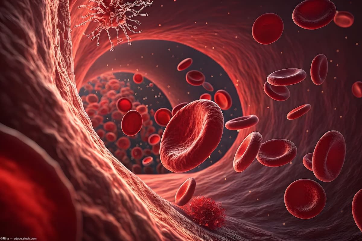 Treating ophthalmic artery stenosis in geographic atrophy with angioplasty