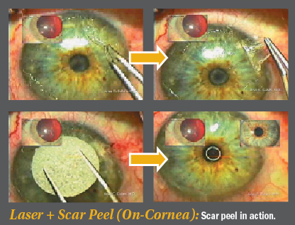 Decoding Corneal Scars Straight To 20 20