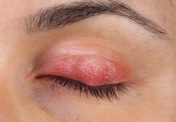 Considering Demodex infestation and cataract surgery