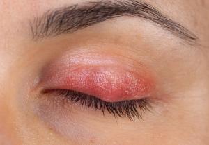 Considering Demodex infestation and cataract surgery