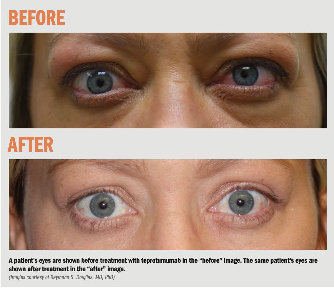 A new tool to treat TED