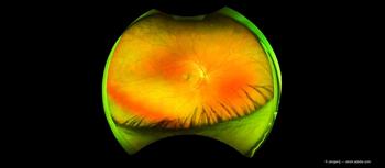 Glaucoma