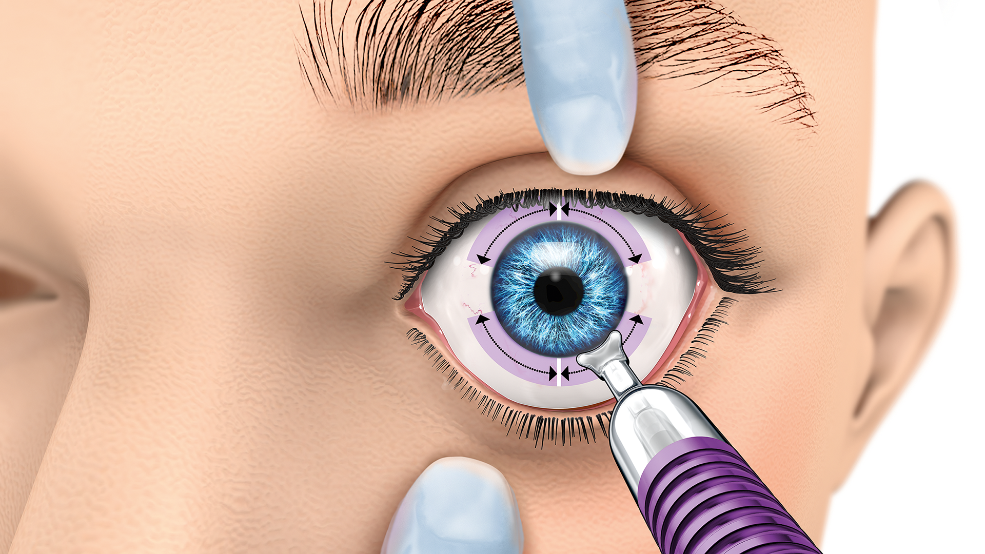 advances in cyclophotocoagulation: good, better, best options