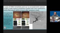 EP. 13 NeuroOp Guru: Two cases of CRAO occurring immediately postoperatively