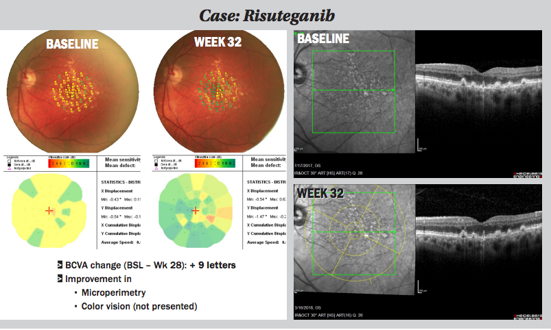 Risuteganib: Exploring Novel Dry AMD Treatment