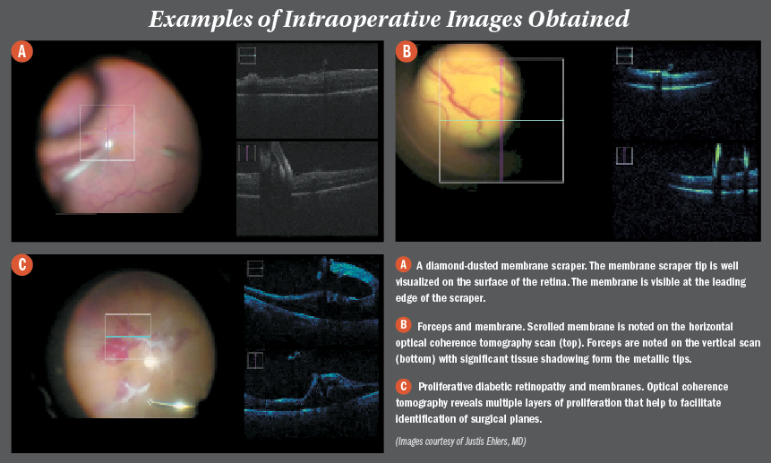Using microscope-integrated intraoperative OCT in VR surgery