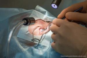 Refractive-cataract surgery: Overview of the current landscape