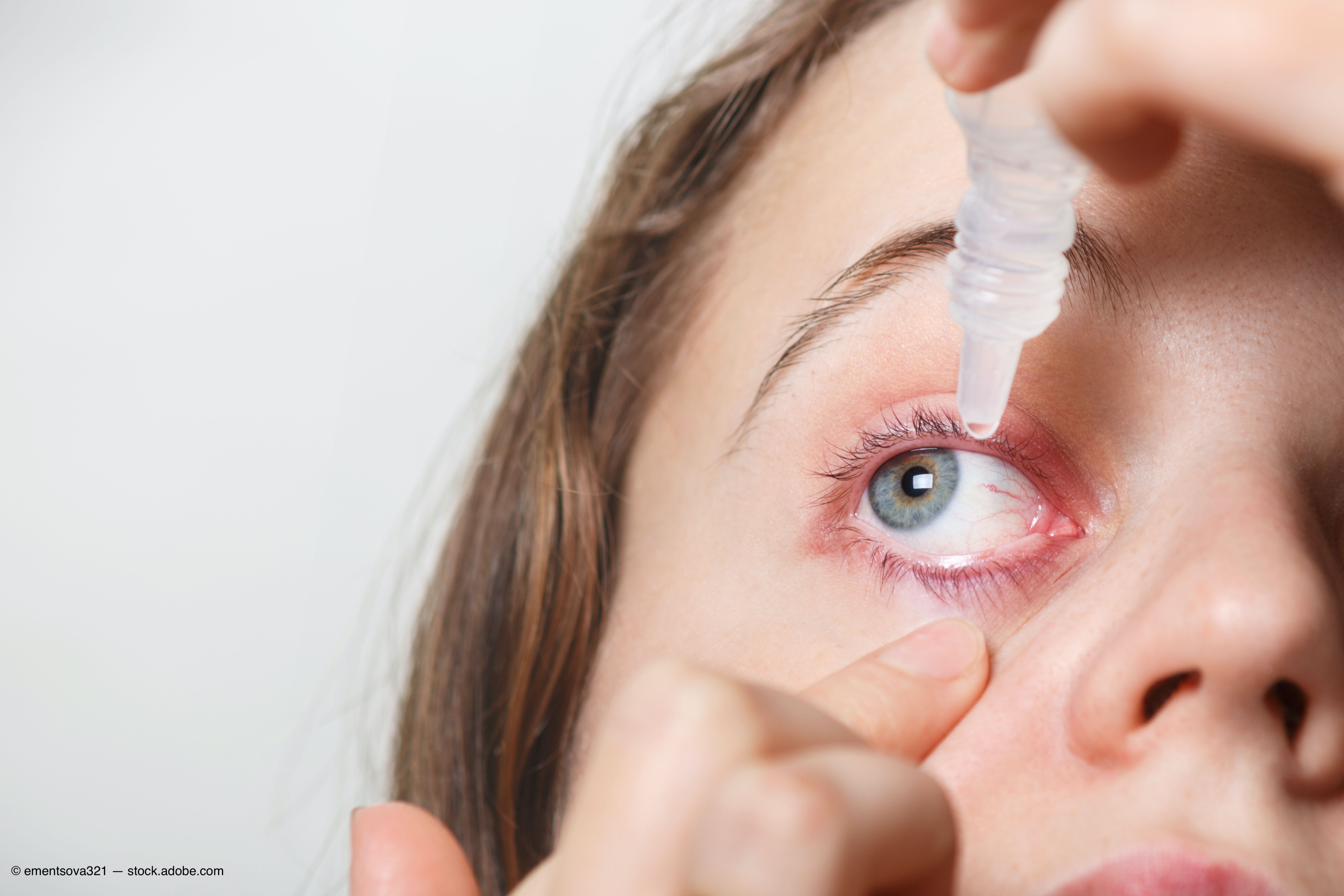 Myths and misconceptions about autologous serum for dry eye ...