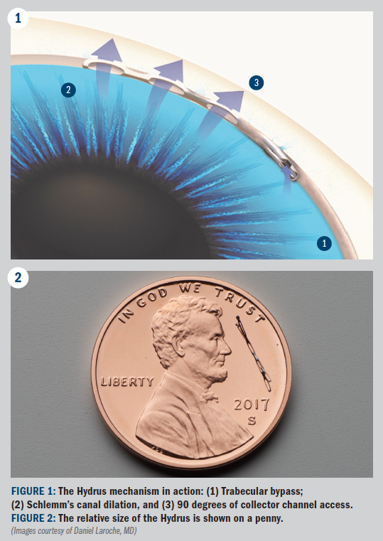 Controlling adult with cataract surgery, stent