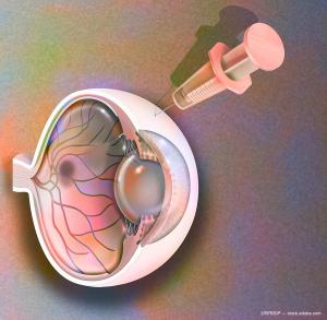 Beyond VEGF-A: Next-generation therapies aim to enhance vision and quality of life in neovascular AMD
