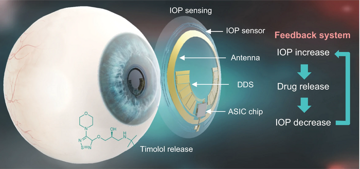 Schematic illustration of a theranostic smart contact lens for glaucoma treatment. (Image courtesy of POSTECH)