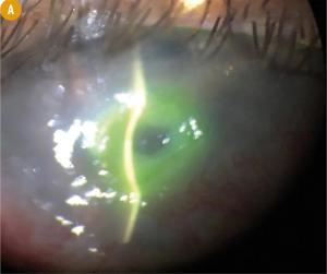 Shedding light on antimicrobial effect of CXL, UV