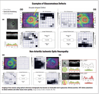 Optical coherence tomography (OCT) imaging of the macula for glaucoma detection