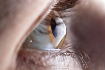 Exploring collagen cross-linking as a treatment for keratoconus