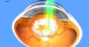 Advances in floater treatment