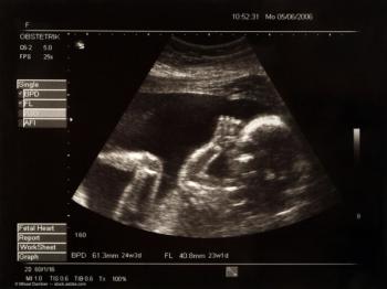 Diabetes during pregnancy linked to eye issues in children
