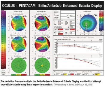 Working out the mystery of ectasia risk with artificial intelligence