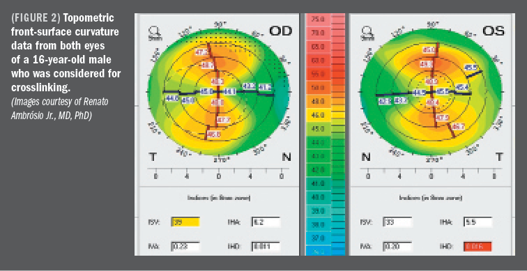 Normal Corneal Topography
