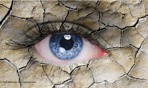 Are you treating conjunctivochalasis effectively for dry eye relief?