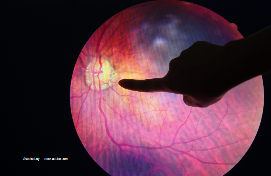 What faricimab for DME means for safe, durable treatment over the long term