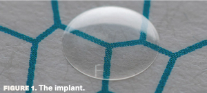 Artificial DMEK could help tackle endothelial donor tissue shortage