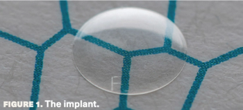 Artificial DMEK could help tackle endothelial donor tissue shortage