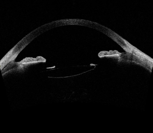 Surgical pearls for IOL explantation