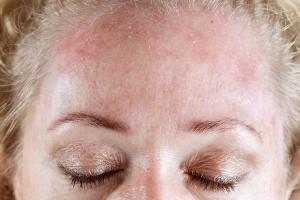 Seborrheic dermatitis linked to multiple epithelial barrier diseases