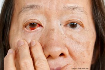 Conjunctival hemorrhages