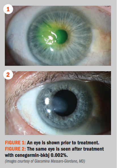 Compound Eye As Treatment For Neurotrophic Keratitis