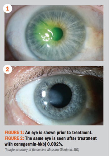 neurotrophic keratitis