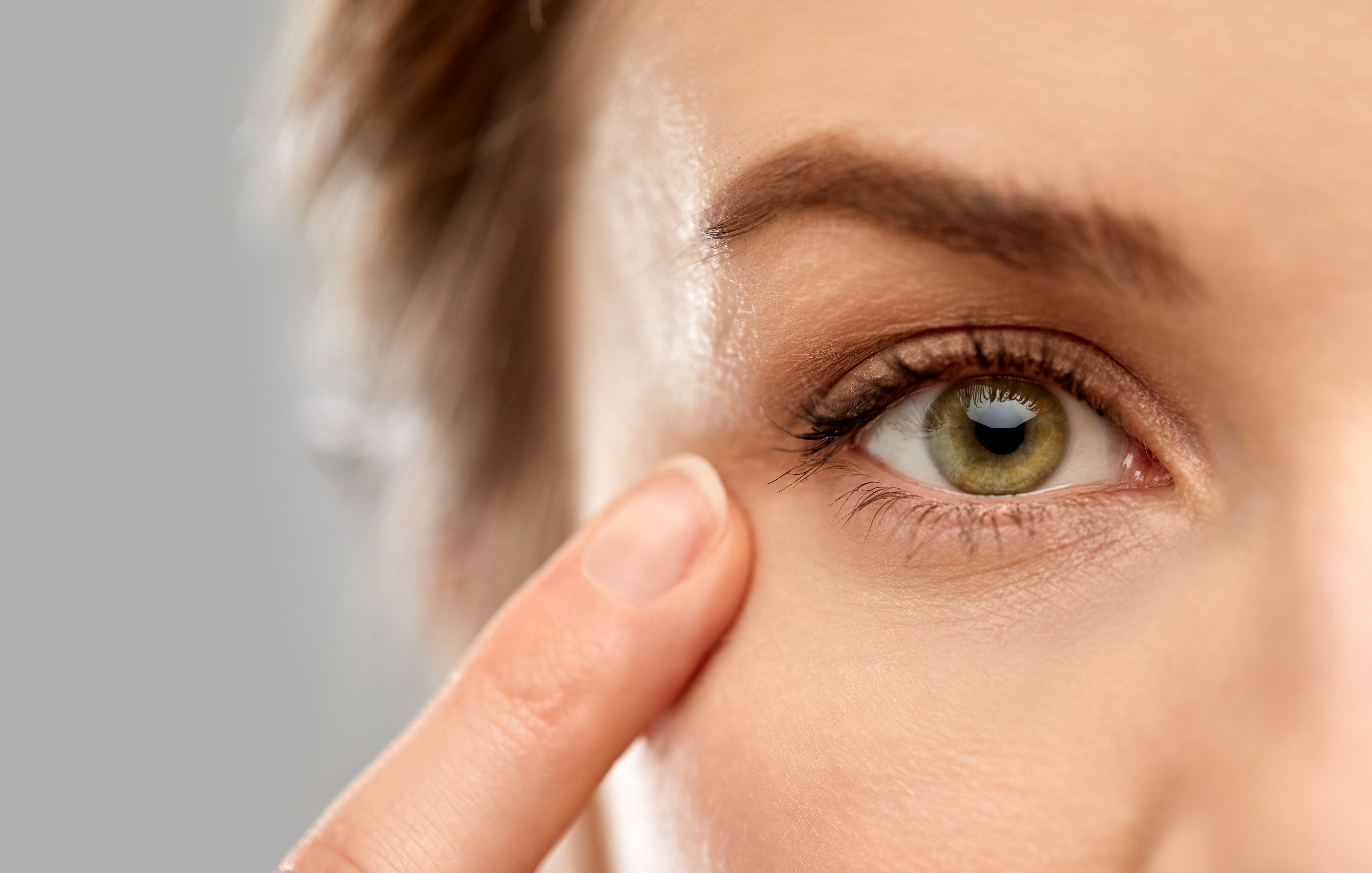 Applying Burt's Bees to the eyelids can result in chemical irritation to the eyelids themselves, and ophthalmologists will see redness, swelling, and inflammation in these patients. (Adobe Stock image)
