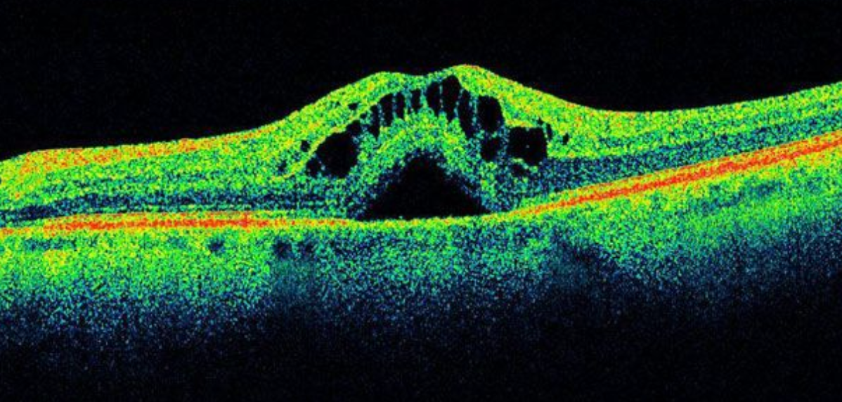 ASRS 2020: New imaging modalities offering bold, noninvasive, real-time monitoring of retinal diseases