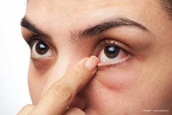 dry eyes