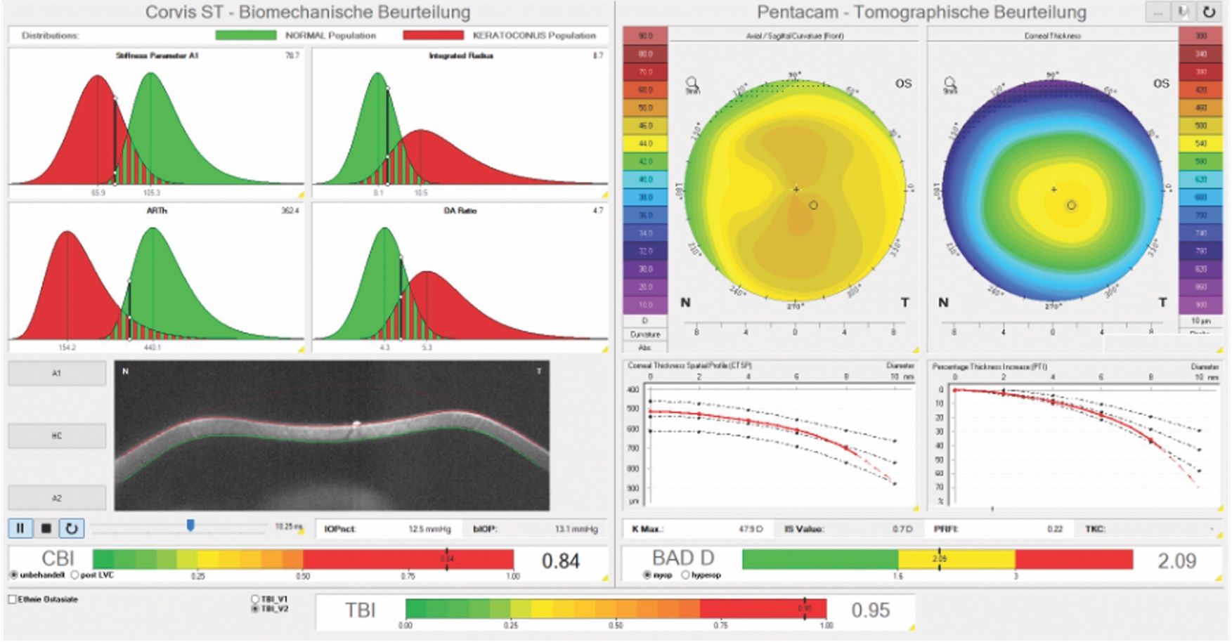 Artificial Intelligence For The Early Detection Of Ectatic Corneal Diseases