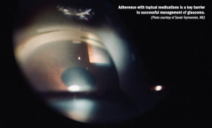 Long-acting prostaglandin implant creating shift in IOP-lowering therapy