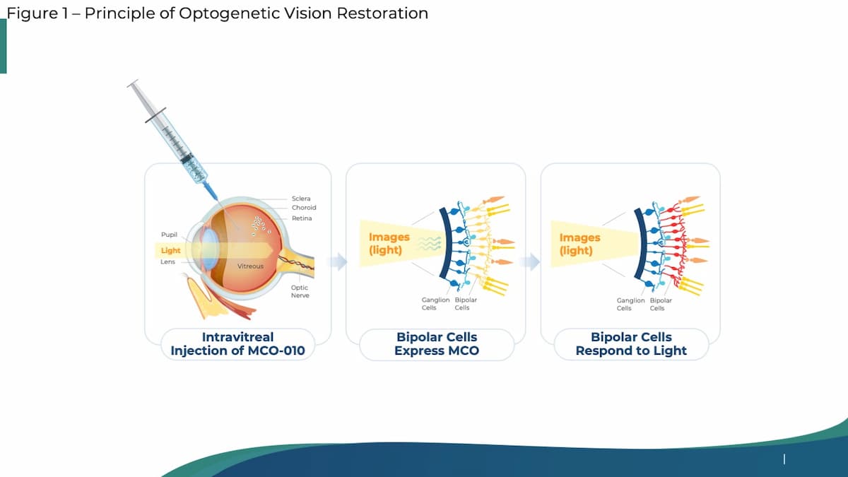 MCO-010 optogenetic gene therapy for severe vision loss in Stargardt ...