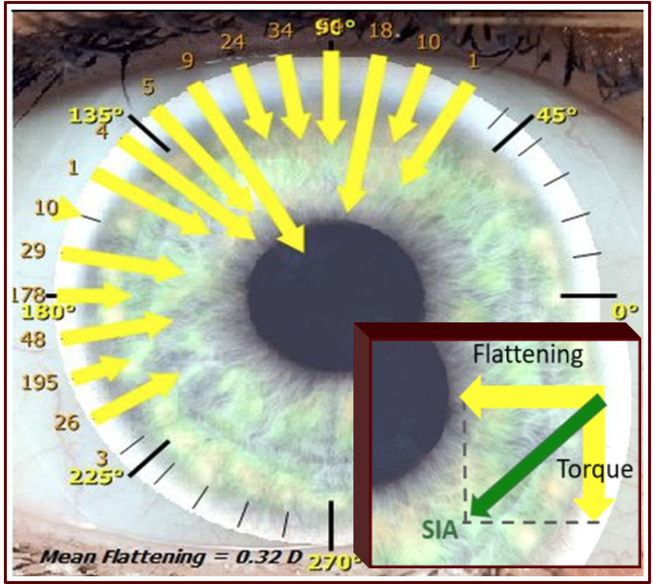 Fattening effect (FE) and torque effect