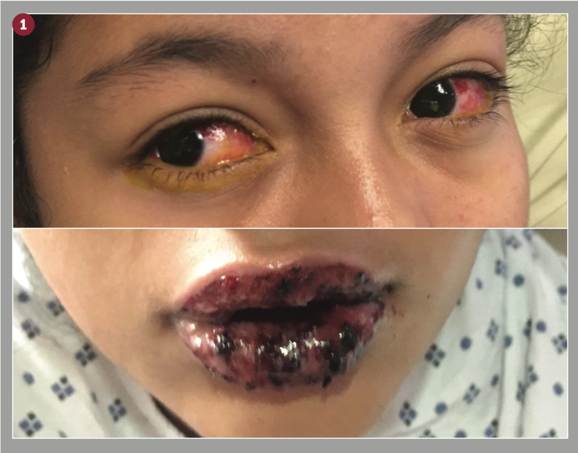 Figure 1: An external photo shows bilateral conjunctival injection and oral ulceration during initial hospitalization. (Image courtesy of Haoxing Douglas Jin, MD)