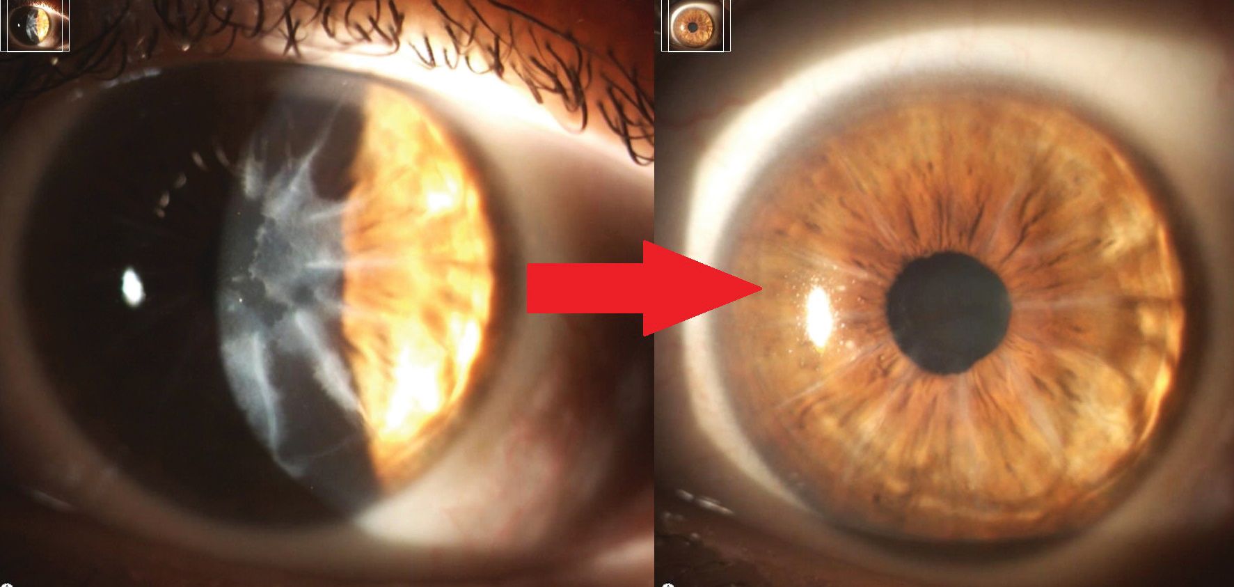 LaZrPlastique: LASIK without cutting the cornea 6 e28d42cd6c7ee08fc3ef02a2a7b673086075f3ee