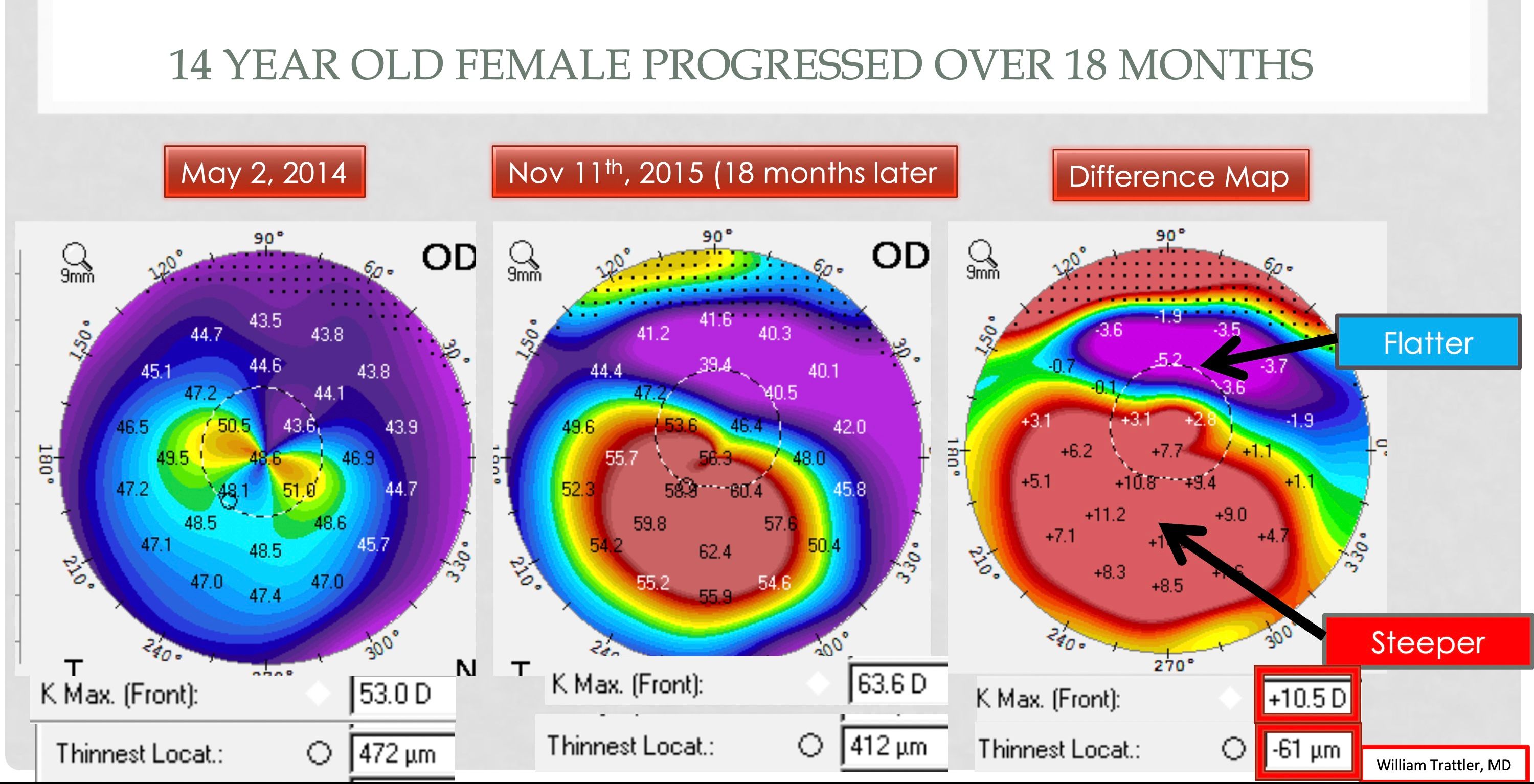 Difference Maps Key To Slowing Keratoconus In Patients