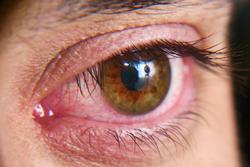Clinical trial for treatment of dry eye disease clears Phase 2 hurdle