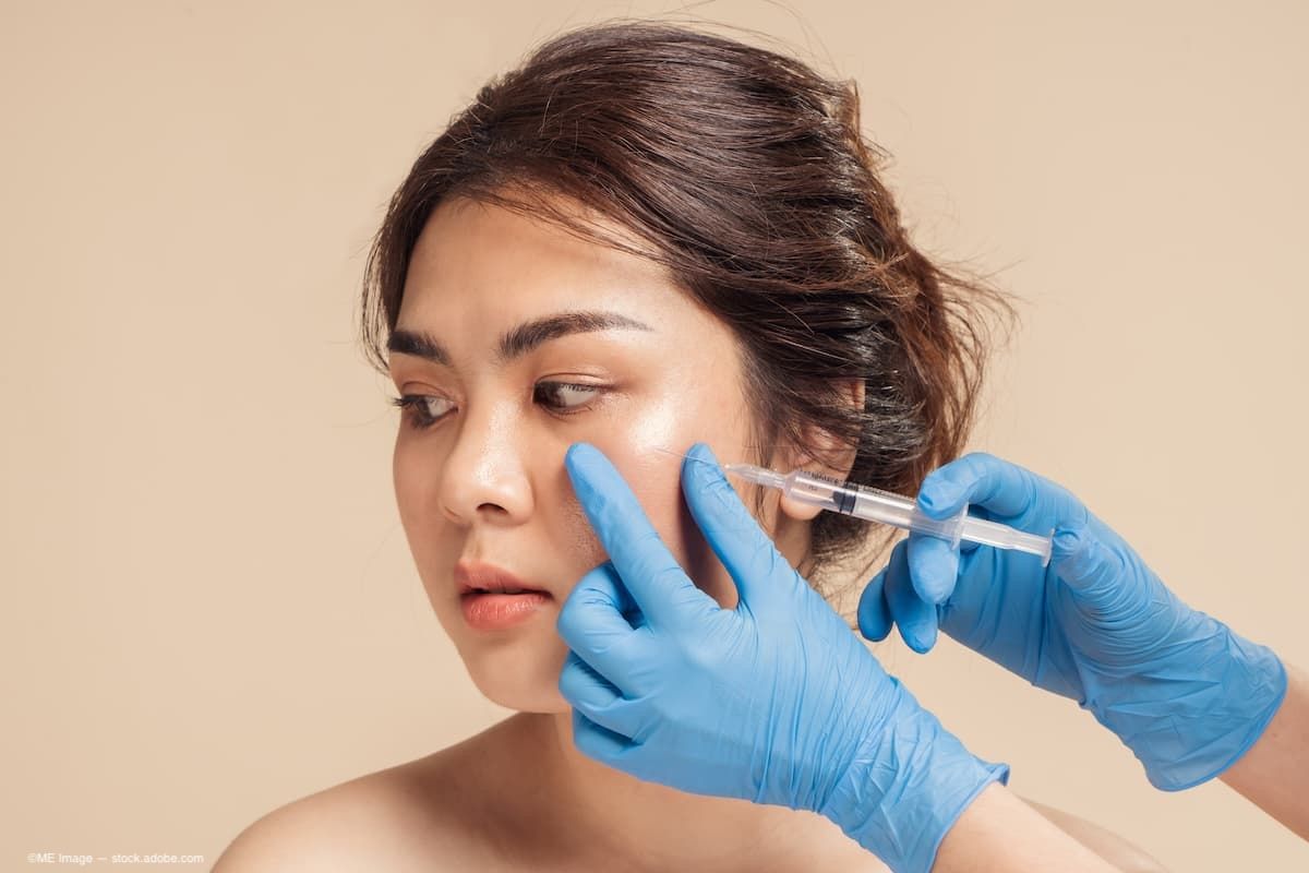 Under-eye filler: Cannula vs needle in tear trough treatment
