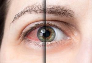 Mixed signals and mounting frustrations: ophthalmologists on dry eye disease