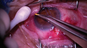 Dexamethasone ophthalmic insert matches drops for inflammation control