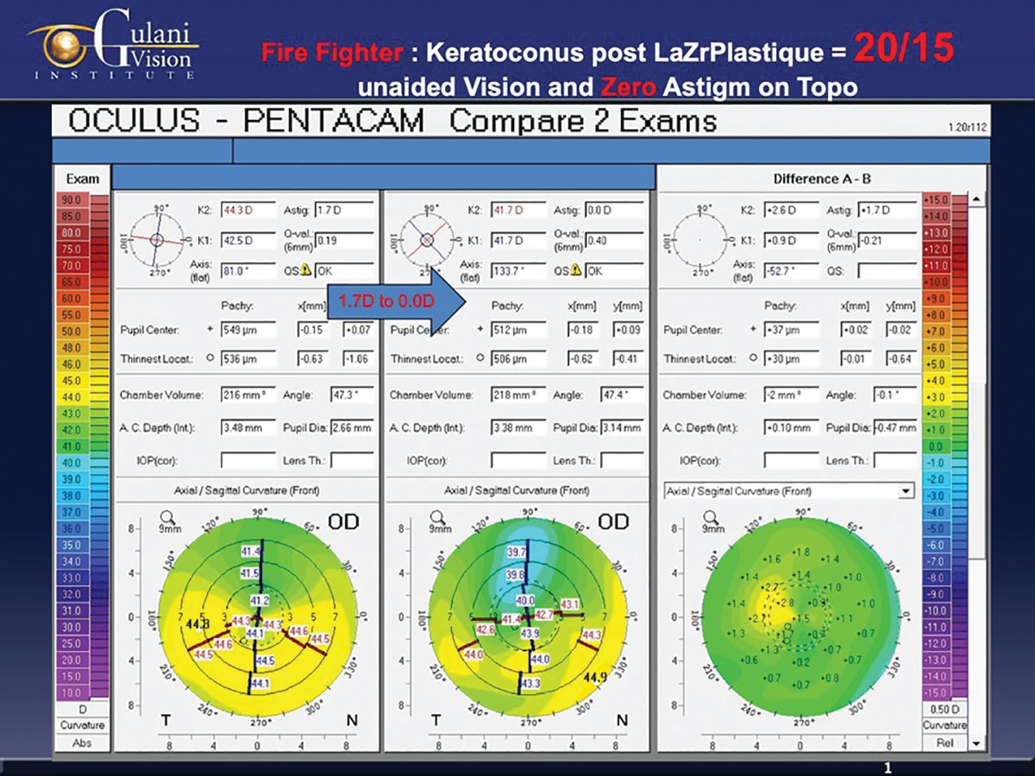 LaZrPlastique: LASIK without cutting the cornea 3 LaZrPlastique: LASIK without cutting the cornea