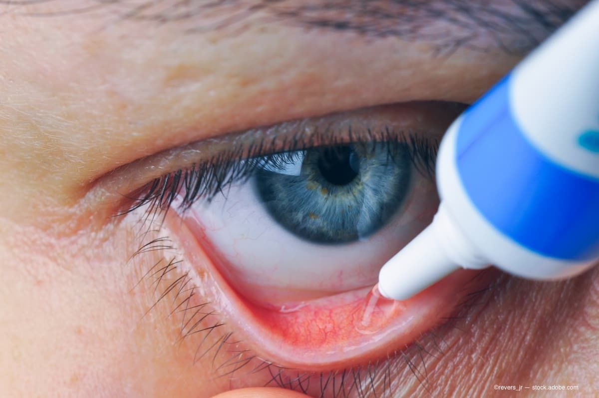 A patient applying eye ointment to their eye