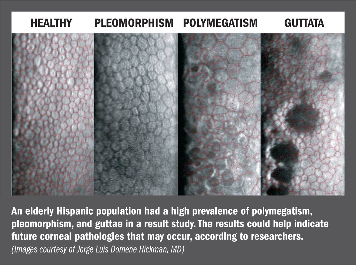 corneal-endothelium-characteristics-vary-depending-on-patient-ethnicity