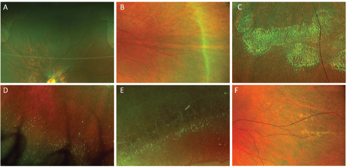 Ultra-widefield red-green images (California; Optos) demonstrating the principal peripheral retinal findings observed in this cohort of children with high myopia. The lesions are arranged according to decreasing frequency: (A) dark without pressure (52.9%), seen as flat, sharply bordered areas of peripheral darkening; (B) white without pressure (36.8%), appearing as pale, translucent peripheral bands; (C) snail track degeneration (17.2%), characterized by elongated, glistening patches with a frosted appearance; (D) microcystoid degeneration (12.6%), presenting as clusters of small, round cystic changes in the far periphery; and (E) lattice degeneration (11.5%), showing localized peripheral thinning with linear or crisscrossing white markings. (F) An example of a peripheral retinal abnormality that could not be assigned to established diagnostic categories; collectively, such unclassified findings constituted the second most common lesion group in children aged 4 to 6 years. (Figure courtesy of Jacques Bijon, MD, and Thibaut Chapron, MD, PhD)